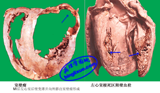 心肌梗死的併發症