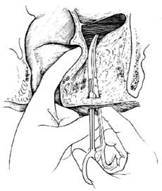 肛管直腸周圍膿腫