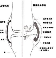 膝關節骨性關節炎