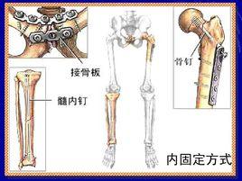 股骨上端骨折內固定術