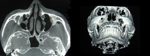 &&上頜前庭溝切口徑路復位M型顴弓骨折