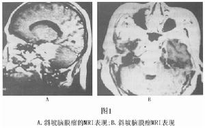 岩骨斜坡腦膜瘤