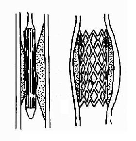 經皮血管腔內成形術