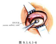 外耳道良性腫瘤切除術