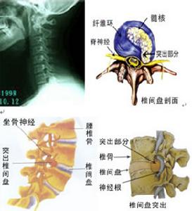 運動系統慢性損傷