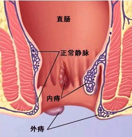 南昌痔瘡網