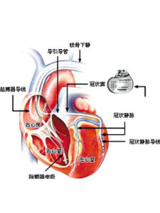 心臟起搏器