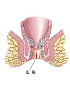 肛裂便血