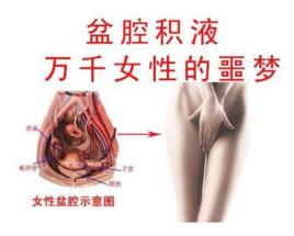 病理性盆腔積液