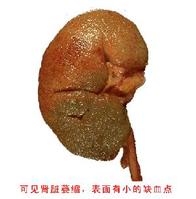 惡性腎小動脈硬化