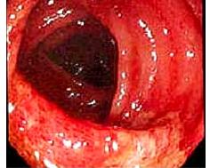 （圖）老年人缺血性結腸炎