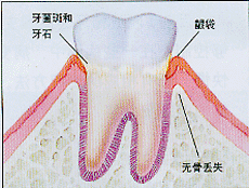 青少年牙周炎