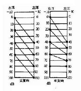 聽力檢查法