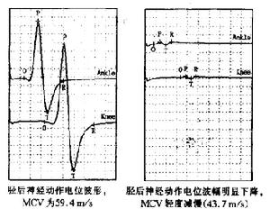 脊髓栓系綜合徵