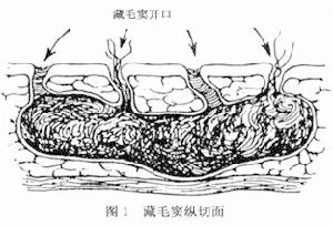 藏毛性疾病