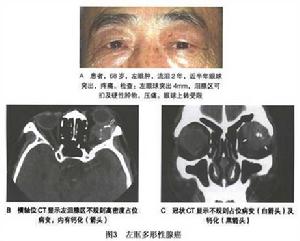 淚腺多形性腺癌