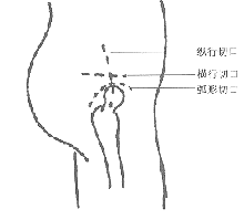 先天性外展性髖攣縮