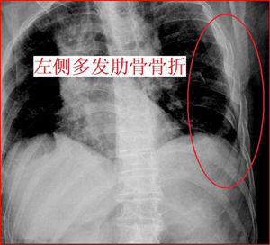 胸骨骨折