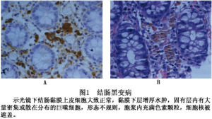 結腸黑變病