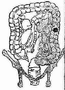 結腸癌圖