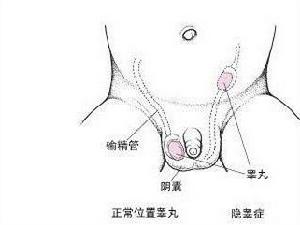 睪丸下降不全