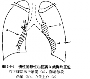 慢性肺源性心臟病