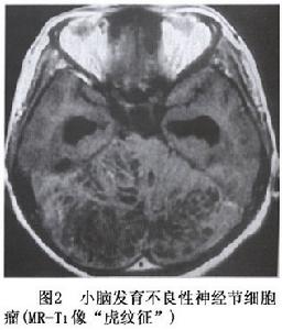 神經元腫瘤和神經元與神經膠質混合性腫瘤