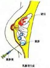 單純性乳腺增生症