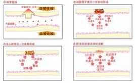 低凝血酶原血症