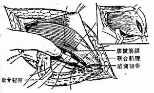 疝