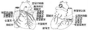 心肌梗塞並發左心室室壁瘤