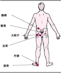 難免性褥瘡