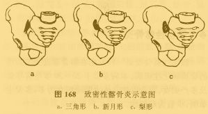 緻密性髂骨炎