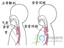 先天性食管閉鎖