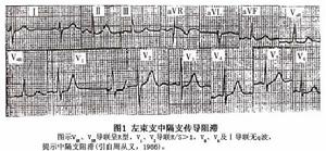 左束支中隔支傳導阻滯