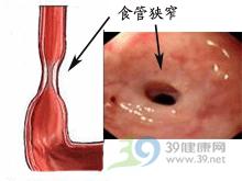 食管瘢痕性狹窄