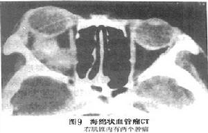 眶內海綿狀血管瘤