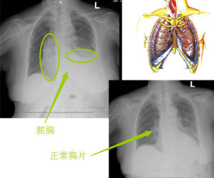 急性膿胸