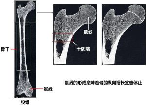 骺線