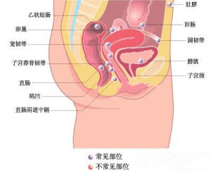 宮外孕現象