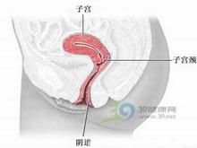 陰道粒細胞肉瘤