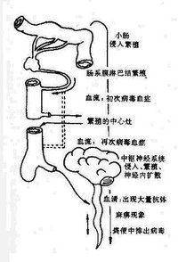 脊髓灰質炎病毒