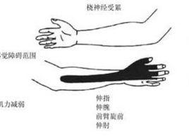 前臂外側和手指觸電樣疼痛