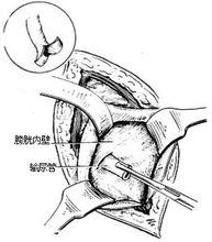 圖3:將輸尿管拉入膀胱內(示意圖)