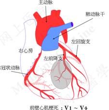 心肌梗死