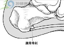 跟骨骨刺綜合症