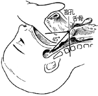 甲狀腺舌管囊腫與瘺