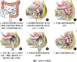 出口梗阻型便秘