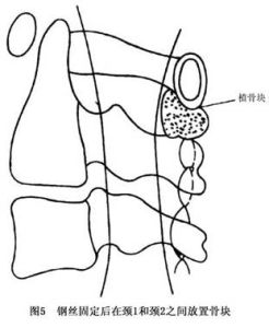 單純性寰樞椎脫位