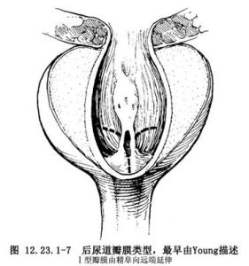 先天性後尿道瓣膜